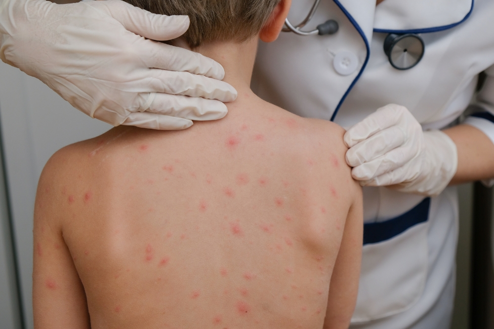 Chickenpox